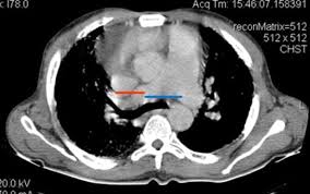Image result for Cor Pulmonale