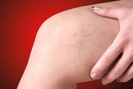 Maybe you would like to learn more about one of these? Red Vein Broken Capillaries Removal Procedure At Luxe Electrolysis Clinic In Leeds Luxe Hair Skin Clinic