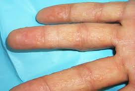 Dia kata sakit psoriasis ni satu je ubat dia sebenarnya. Eczema Atau Psoriasis Dr Zubaidi Hj Ahmad Menulis