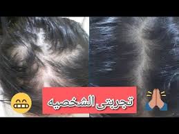 ازاى عالجت فراغات شعرى تجربتى الحقيقيه وصفه ممتازه لانبات الشعر Youtube