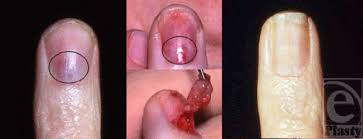 Image result for Glomus tumor