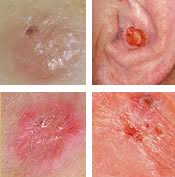 If breast cancer is diagnosed at an early enough stage, it's treatable. Types Of Cancer The Skin Cancer Center