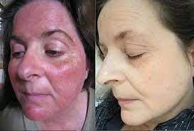 Efficacy and safety of ivermectin 1% cream in treatment of papulopustular rosacea: Rosacea Wikiwand