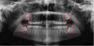 Î‘Ï€Î¿Ï„Î­Î»ÎµÏƒÎ¼Î± ÎµÎ¹ÎºÏŒÎ½Î±Ï‚ Î³Î¹Î± wisdom teeth