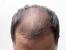 Scalp Thin Hair Men
