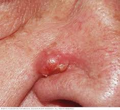 Sebaceous filaments (aka sebum plugs) are collections of that oily liquid. Epidermoid Cysts Symptoms And Causes Mayo Clinic