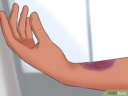 As you slip, you automatically stick your hand out to break recovery time depends on how serious your wrist sprain is. How To Tell If Your Wrist Is Sprained 7 Steps With Pictures