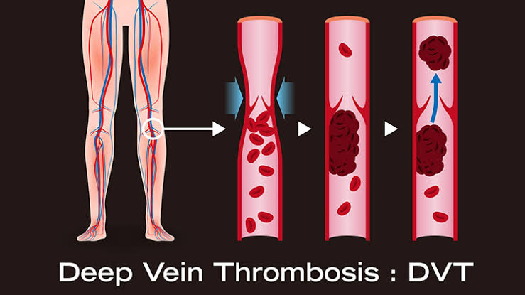 Deep Vein Thrombosis (DVT): Symptoms and Treatment - Prof. Dr. Selim İsbir
