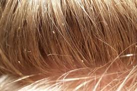 If you got short mane but want to make it work, extensions will do the job. What Does Lice Look Like In Blonde Hair And How To Remove Them