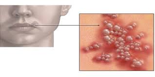 Immunoperoxidase staining by a monoclonal antibody is available to herpes simplex types 1 and 2 and to varicella zoster. Alarming Changes In Transmission Of Herpes Virus In Asia Says Wcm Q Research Marhaba Qatar