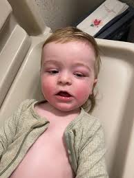 Have you ever had trouble distinguishing between EOE Symptoms and other  allergic reactions? Learn how to tell the difference in the slides provided  to CEGIR by Dr. Corey Ketchum.