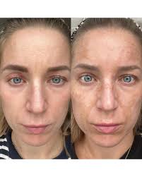 This is how we feel when someone gets results that genuinely change how  they see themselves. From constantly covering pigmentation to finally  feeling confident in her own skin, this lovely client came