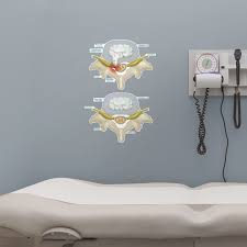 Prolapsed Disc Body Part Chart Removable Wall Graphic