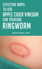 How Effective Is Apple Cider Vinegar For Ringworm Treatment Apple Cider Vinegar For Skin Apple Cider Vinegar Remedies Cider Vinegar