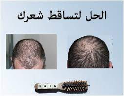 ٢٠ طريقة لعلاج تساقط الشعر للرجال فنجان