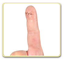 An object pierces a hole through the lip or cuts across the border where the lip meets the face. When Does A Wound Need Stitches Edocamerica