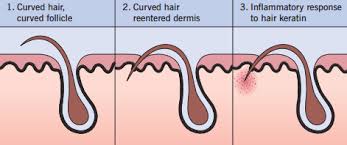 Ingrown hair are caused by shaving, waxing and wearing tight clothing. Pin On Beauty Loves