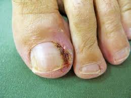 Image result for Akutní zánět nehtového lůžka