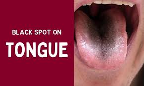 Image result for black tongue symptoms