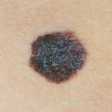 Check spelling or type a new query. What Skin Cancer Looks Like Health Com