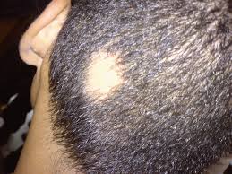 This causes more hair to fall out, sometimes in handfuls. Alopecia Areata Wikipedia