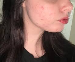 Hey All! Any tips or product recommendations for this? My pores look like  creaves and craters and I hateeeee it! I know nothing will completely get  rid of them but looking for