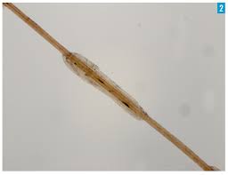 There are other signs that can more accurately indicate a problem. White Spots On The Hair Does This Woman Have Head Lice Consultant360