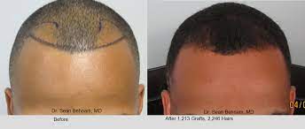 But most of us only get. Men S African American Hair Transplant Dr Sean Behnam