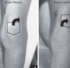 Image result for Ballottable Patella Sign