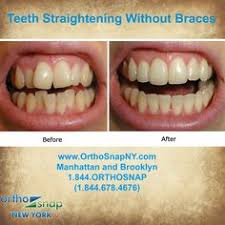 If your teeth aren't currently. 140 Best Straighten Teeth Without Braces Ideas Straighten Teeth Without Braces Teeth Straightening Teeth