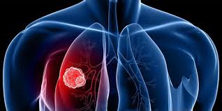 What is usually the first sign of lung cancer? Lung Cancer Causes Symptoms Treatment About Pakistan