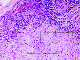 Idiopathic Orbital Inflammatory Syndrome Clinical Features And Treatment Outcomes British Journal Of Ophthalmology