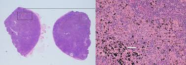 It level plodovnica po kapljicah sunday funday ex 2012 tarik phillips wvu scottish wool, per fisher. Elusive Diagnosis Of Lymphadenopathy In A Young Woman Bmj Case Reports