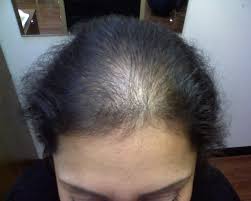 Hair loss and thin, brittle hair can be a symptom of iron deficiency. Protein Deficiency Hair Loss