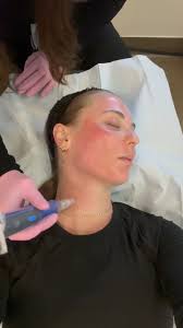 The HydraNeedle! 🙌 , A Deluxe Hydrafacial with Microneedling combines 2  amazing treatments to treat fine lines, scarring, build collagen, deeply  exfoliate the skin, clean out your pores, treat acne ...