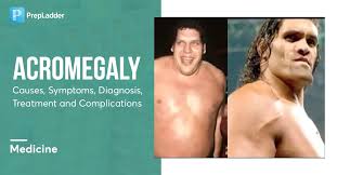 Image result for Acromegaly
