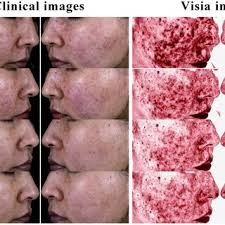 PDF) Ferulic Acid in the Treatment of Papulopustular Rosacea: A Randomized  Controlled Study