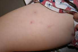 Painful lump on thigh symptoms Get Rid Of Ingrown Hairs On Legs Fast Ingrown Hair