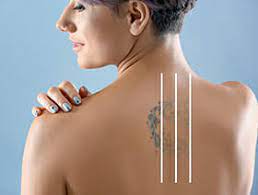An all natural aftercare stick for your tattoos and hydrating boost for your healed ones. Picoway Laser Tattoo Removal Riversidemedicalarts Com