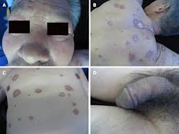 Why is it that europeans brought diseases to the new world. Malignant Syphilis Accompanied With Neurosyphilis In A Malnourished Patient A Case Report