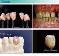 China Glaze Metal Ceramic Dental Porcelain Powder PFM ...
