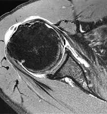 Image result for Shoulder MRI