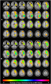 You stated in your responses to my 2 dispute letters that you have verified that the items listed below are accurate but you failed to send me copies of the documents that you used to verify these accounts, as per my request and my legal right. Frontiers Sex Effect On Presurgical Language Mapping In Patients With A Brain Tumor Neuroscience