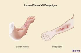 Image result for Pemphigus