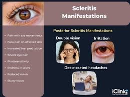 Image result for Scleritis
