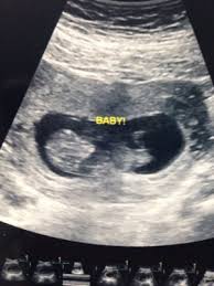 Que Tan Cierto Es El Mito Que Si Los Latidos Del Corazon Del Bebe Son Mayor A 140 Por Minuto Es Nina O Menor Es Nino Mamas Marzo 2016 Ninos Creciendo Felices Babycenter