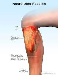 Necrotizing Fasciitis (Flesh-Eating Disease): Causes, Contagious, Symptoms  & Treatment