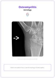 Image result for Osteomyelitis