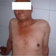 Breast consistency can change with menstruation, pregnancy, menopause, or weight gain. Left Male Breast Cancer Presenting With Gynecomastia Download Scientific Diagram