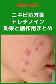トレチノインの皮膚に対する5つの作用 ニキビ フェイスケア ハイドロキノン